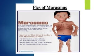 Malnutrition by Sakshi.pdf