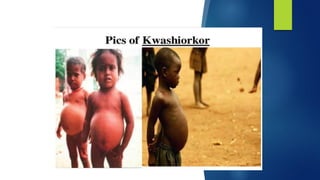 Malnutrition by Sakshi.pdf