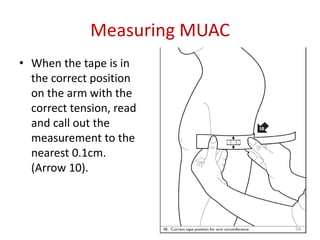 Muac How To Guide Malnutrition harare hosp(3) | PPTX