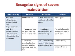 Severe wasting Oedema Dermatosis Eye signs
front view
-ribs easily seen
-upper arms look
loose
-thighs look loose
+ mild: both feet + mild: discoloration
or a few rough patches
of skin
Bitot’s spots –
back view
-ribs and shoulder
bones easily seen
- flesh missing from
the buttocks
+ + moderate: both
feet, plus lower legs,
hands, or lower arms
+ + moderate:
multiple patches on
arms and/or legs
Pus and inflammation
(redness) are signs of
eye infection.
+ + + severe:
generalized oedema
including both feet,
legs, hands, arms and
face
+ + + severe: flaking
skin, raw skin, fissures
(openings in the skin)
Corneal clouding
Corneal ulceration
 