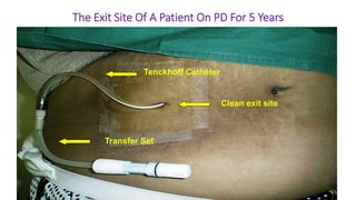 www.pcacorp.com
Tenckhoff Catheter
Clean exit site
Transfer Set
The Exit Site Of A Patient On PD For 5 Years
 