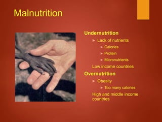 Malnutrition
Undernutrition
 Lack of nutrients
 Calories
 Protein
 Micronutrients
Low income countries
Overnutrition
 Obesity
 Too many calories
High and middle income
countries
http://i105.photobucket.com/albums/m203/sspasha/Malnutrition.jpg
 