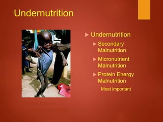 Undernutrition
 Undernutrition
 Secondary
Malnutrition
 Micronutrient
Malnutrition
 Protein Energy
Malnutrition
Most important
Severe Protein
Energy Malnutrition
http://www.bio.davidson.edu/people/kabernd/seminar/2002/tech/ma
lnutrition.jpg
 