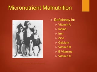 Micronutrient Malnutrition
 Deficiency in:
 Vitamin A
 Iodine
 Iron
 Zinc
 Calcium
 Vitamin D
 B Vitamins
 Vitamin C
Rickets (Vitamin D deficiency)
http://www.talkorigins.org/faqs/homs/rickets.jpg
 
