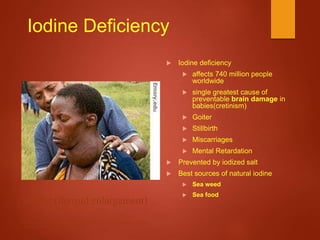 Iodine Deficiency
 Iodine deficiency
 affects 740 million people
worldwide
 single greatest cause of
preventable brain damage in
babies(cretinism)
 Goiter
 Stillbirth
 Miscarriages
 Mental Retardation
 Prevented by iodized salt
 Best sources of natural iodine
 Sea weed
 Sea food
Goiter (thyroid enlargement)
http://www.voanews.com/english/images/emory_edu_goiter_Iodine_Deficiency_Disorder
_195_eng_11may06_0.jpg
 