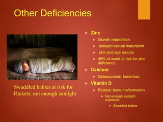 Other Deficiencies
 Zinc
 Growth retardation
 delayed sexual maturation
 skin and eye lesions
 48% of world at risk for zinc
deficiency
 Calcium
 Osteoporosis: bone loss
 Vitamin D
 Rickets: bone malformation
 Not enough sunlight
exposure:
 Swaddled babies
http://www.ulanbatoronline.org/cammp_section/article_images_lamc_lati
mes/scans/latimes_images/thumbnails/babyswaddle.jpg
Swaddled babies at risk for
Rickets: not enough sunlight
 