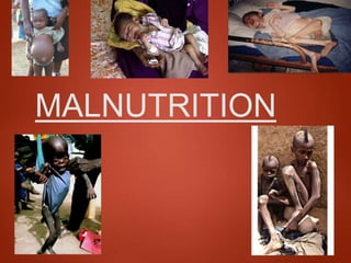 MALNUTRITION
 
