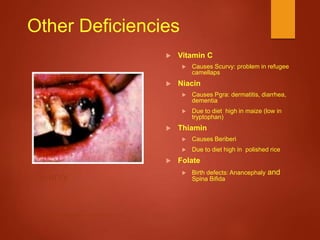 Other Deficiencies
 Vitamin C
 Causes Scurvy: problem in refugee
camellaps
 Niacin
 Causes Pgra: dermatitis, diarrhea,
dementia
 Due to diet high in maize (low in
tryptophan)
 Thiamin
 Causes Beriberi
 Due to diet high in polished rice
 Folate
 Birth defects: Anancephaly and
Spina Bifida
http://www.athropolis.com/arctic-facts/misc/scurvy.jpg
Scurvy
 