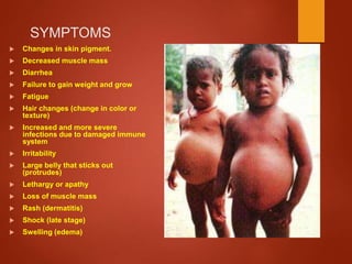 SYMPTOMS
 Changes in skin pigment.
 Decreased muscle mass
 Diarrhea
 Failure to gain weight and grow
 Fatigue
 Hair changes (change in color or
texture)
 Increased and more severe
infections due to damaged immune
system
 Irritability
 Large belly that sticks out
(protrudes)
 Lethargy or apathy
 Loss of muscle mass
 Rash (dermatitis)
 Shock (late stage)
 Swelling (edema)
 