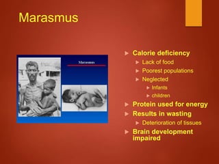 Marasmus
 Calorie deficiency
 Lack of food
 Poorest populations
 Neglected
 Infants
 children
 Protein used for energy
 Results in wasting
 Deterioration of tissues
 Brain development
impaired
 