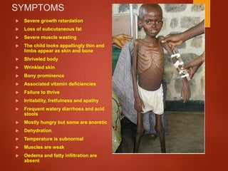 SYMPTOMS
 Severe growth retardation
 Loss of subcutaneous fat
 Severe muscle wasting
 The child looks appallingly thin and
limbs appear as skin and bone
 Shriveled body
 Wrinkled skin
 Bony prominence
 Associated vitamin deficiencies
 Failure to thrive
 Irritability, fretfulness and apathy
 Frequent watery diarrhoea and acid
stools
 Mostly hungry but some are anoretic
 Dehydration
 Temperature is subnormal
 Muscles are weak
 Oedema and fatty infiltration are
absent
 