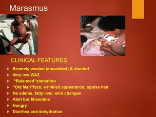 Marasmus
 Severely wasted (emaciated) & stunted
 Very low WAZ
 “Balanced”starvation
 “Old Man”face, wrinkled appearance, sparse hair
 No edema, fatty liver, skin changes
 Alert bur Miserable
 Hungry
 Diarrhea and dehydration
CLINICAL FEATURES
 