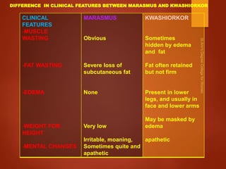 CLINICAL
FEATURES
-MUSCLE
WASTING
-FAT WASTING
-EDEMA
-WEIGHT FOR
HEIGHT
-MENTAL CHANGES
MARASMUS
Obvious
Severe loss of
subcutaneous fat
None
Very low
Irritable, moaning,
Sometimes quite and
apathetic
KWASHIORKOR
Sometimes
hidden by edema
and fat
Fat often retained
but not firm
Present in lower
legs, and usually in
face and lower arms
May be masked by
edema
apathetic
DIFFERENCE IN CLINICAL FEATURES BETWEEN MARASMUS AND KWASHIORKOR
 