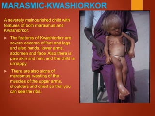 A severely malnourished child with
features of both marasmus and
Kwashiorkor.
 The features of Kwashiorkor are
severe oedema of feet and legs
and also hands, lower arms,
abdomen and face. Also there is
pale skin and hair, and the child is
unhappy.
 There are also signs of
marasmus, wasting of the
muscles of the upper arms,
shoulders and chest so that you
can see the ribs.
MARASMIC-KWASHIORKOR
 