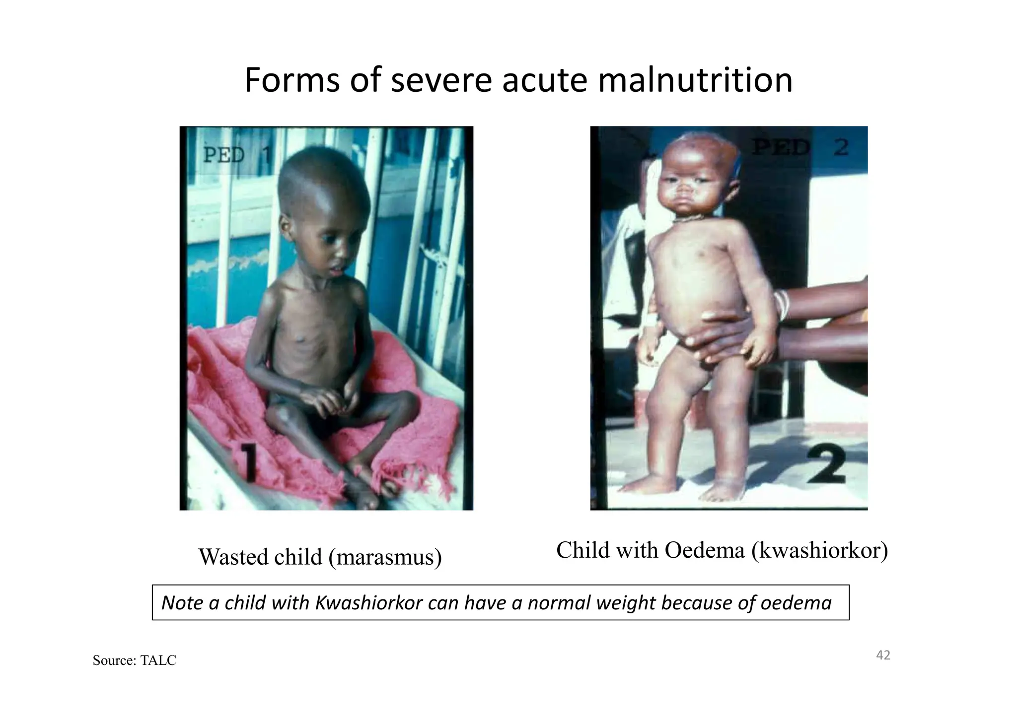 Forms of severe acute malnutrition
42
Source: TALC
Wasted child (marasmus) Child with Oedema (kwashiorkor)
Note a child with Kwashiorkor can have a normal weight because of oedema
 
