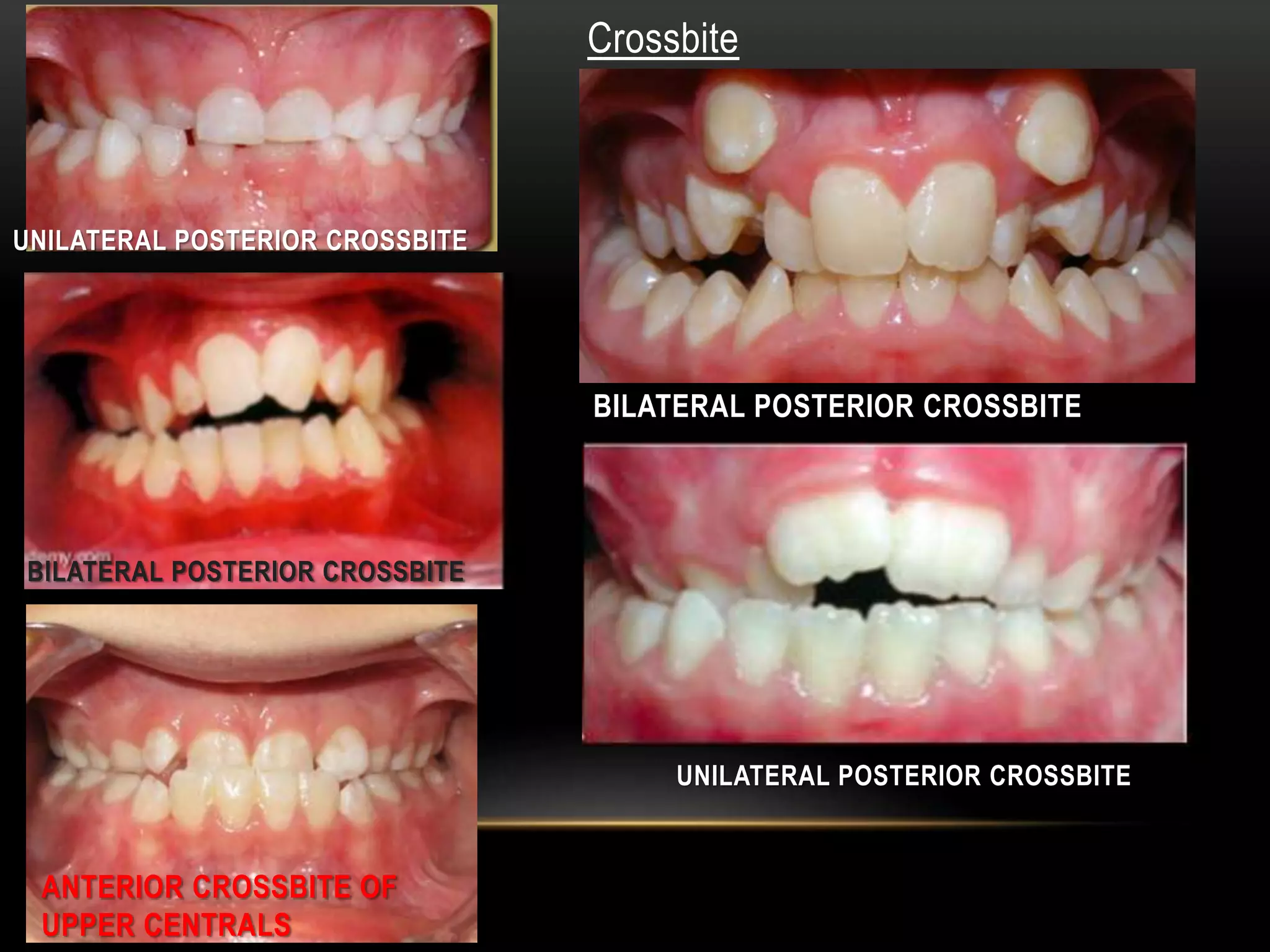 Left Crossbite Malocclusion - Dr. Maher Fouda | PPTX