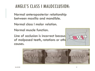 MALOCCLUSION ORTHODONTICS classification.pptx