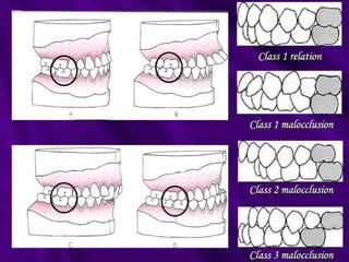 MALOCCLUSION ORTHODONTICS classification.pptx