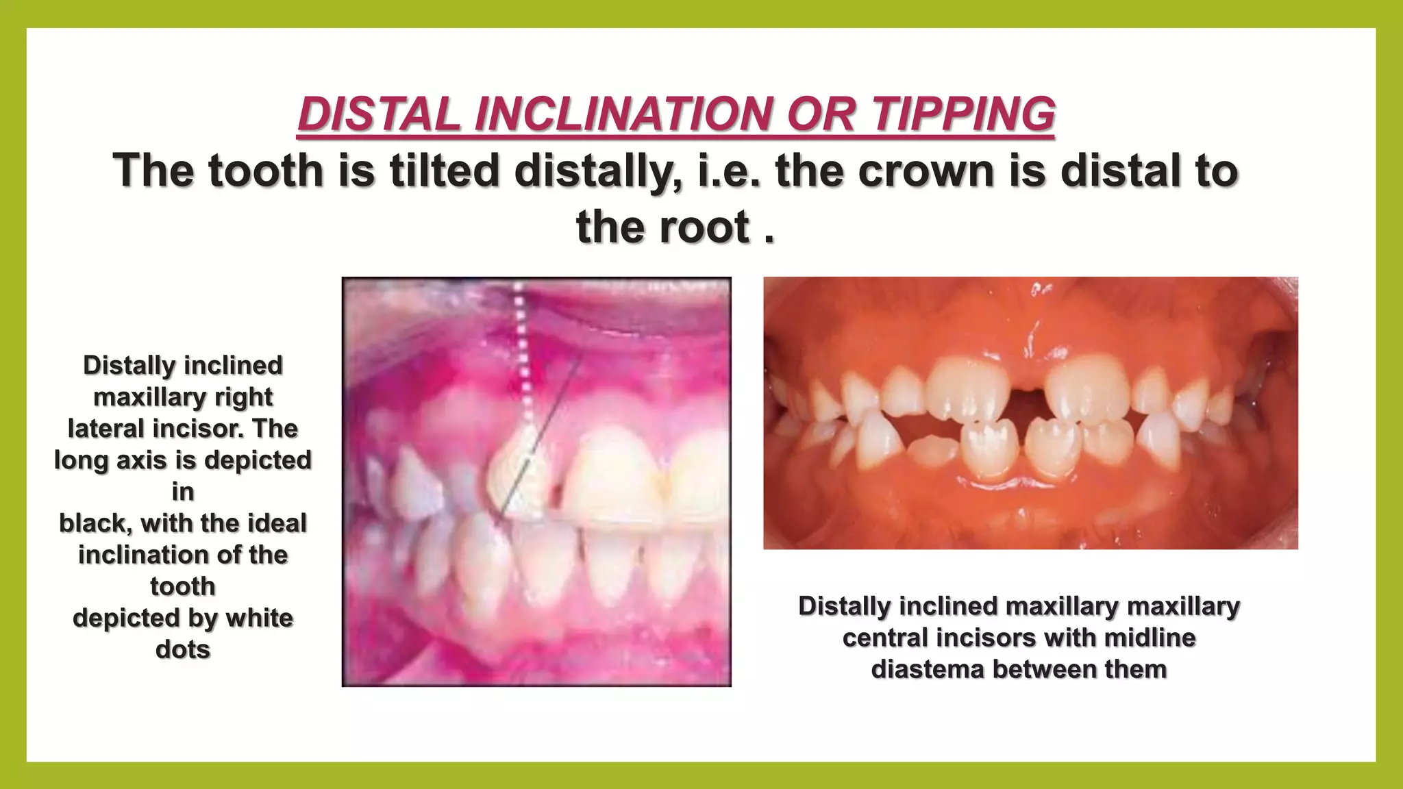 Malocclusion of teeth | PPTX