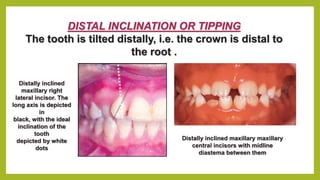 Malocclusion of teeth | PPTX