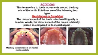 Teeth Alignment Rotations Malocclusion of teeth | PPTX