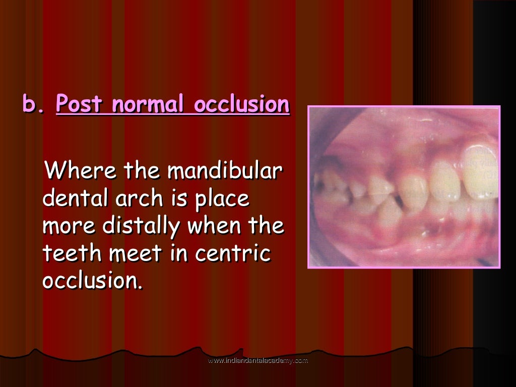 Malocclusion /certified fixed orthodontic courses by Indian dental…