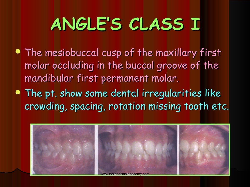 Malocclusion /certified fixed orthodontic courses by Indian dental…