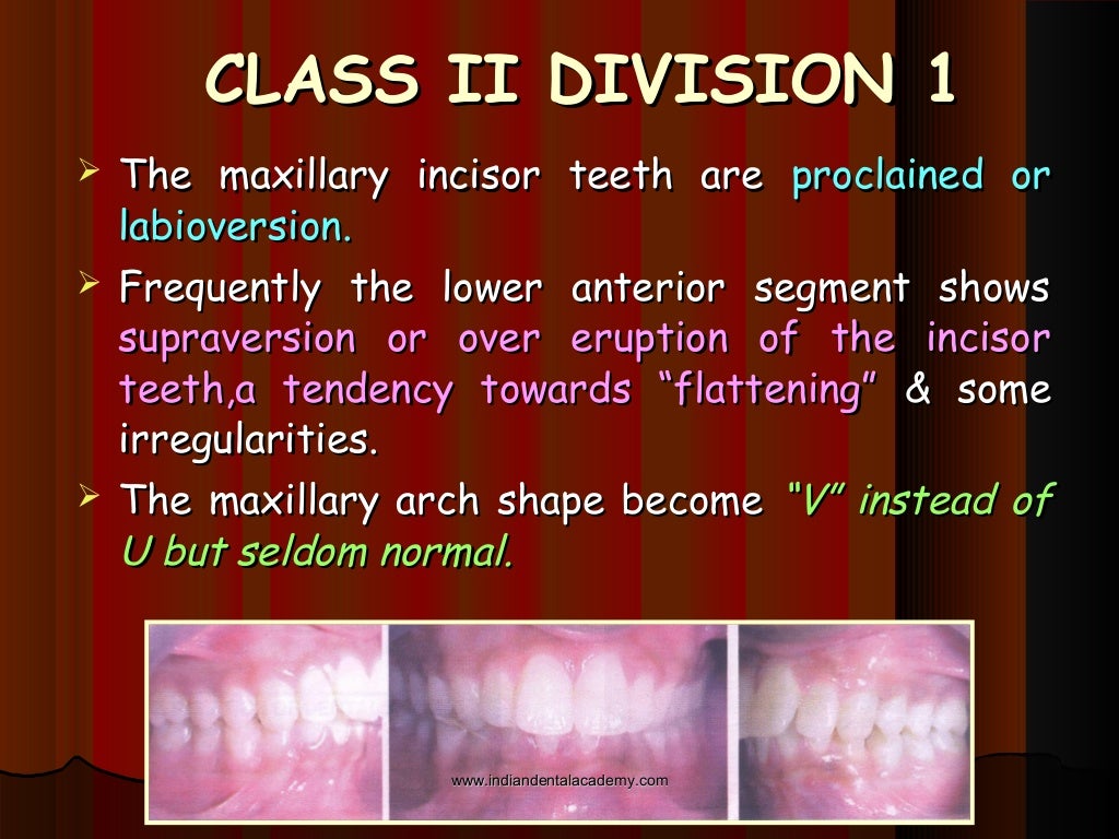 Malocclusion /certified fixed orthodontic courses by Indian dental…