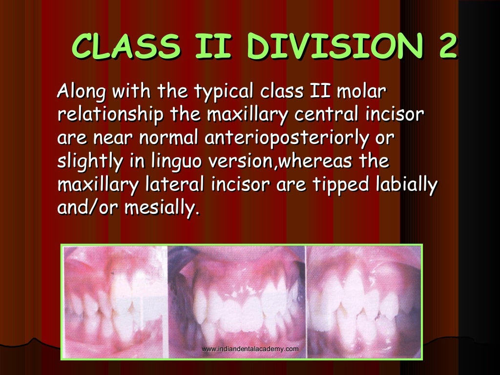 Malocclusion /certified fixed orthodontic courses by Indian dental…