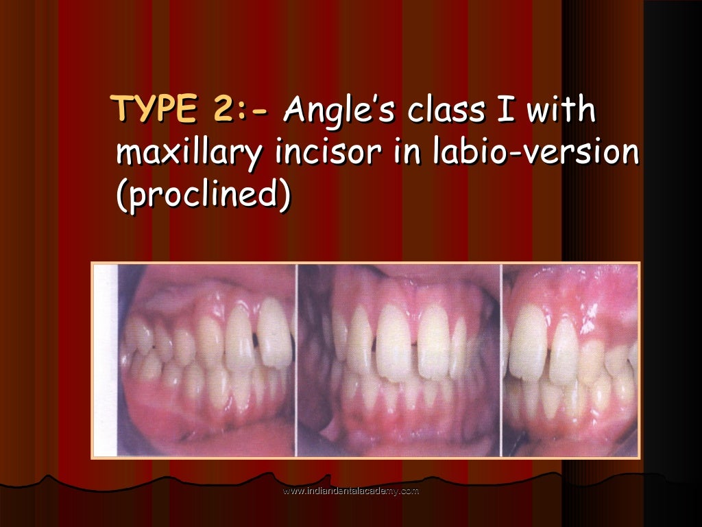 Malocclusion /certified fixed orthodontic courses by Indian dental…