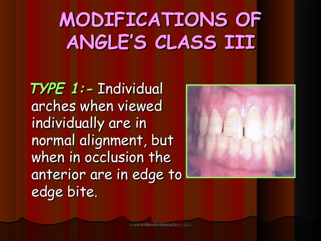 Malocclusion /certified fixed orthodontic courses by Indian dental…