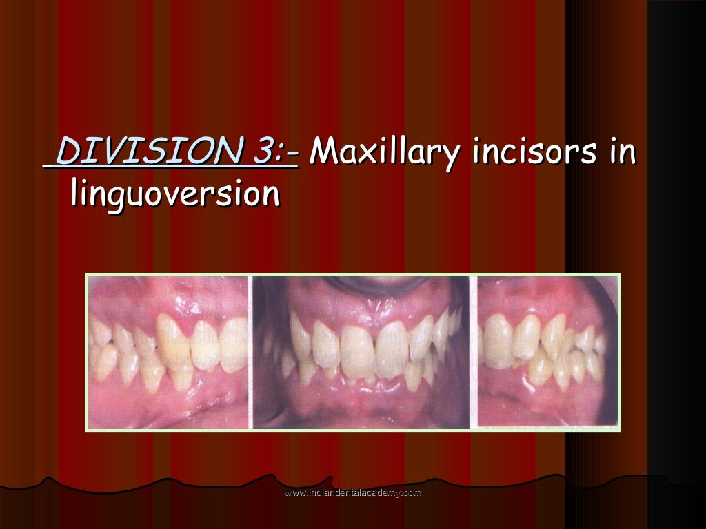 Malocclusion /certified fixed orthodontic courses by Indian dental…