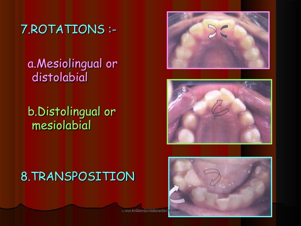 Malocclusion /certified fixed orthodontic courses by Indian dental…