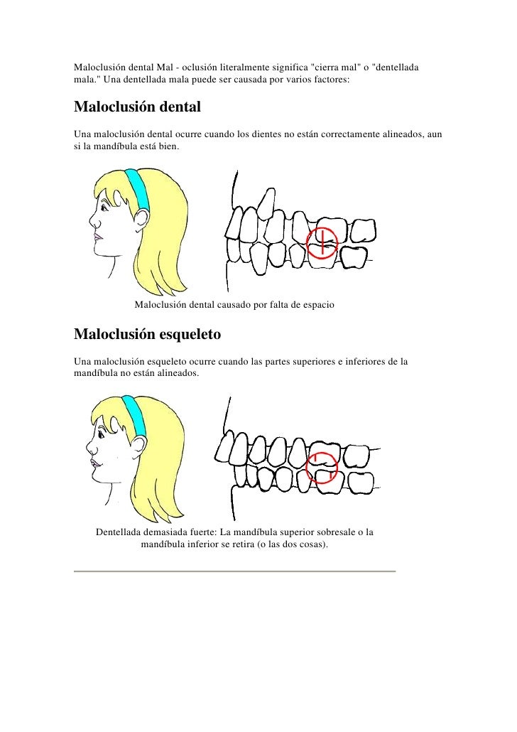 Maloclusión dental mal