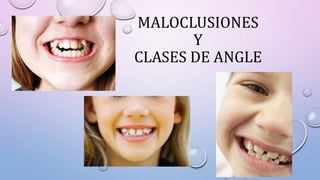 MALOCLUSIONES
Y
CLASES DE ANGLE
 