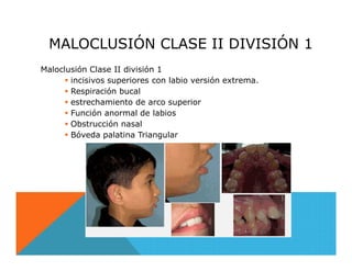 Maloclusion,Tipos y Clasificación | PDF