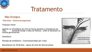 Tratamento
Malposicionamento de cílios
Eletrólise - Diatermocoagulacão
Triquíase menor
Agulhas no infundíbulo do cílio de forma paralela a emergencia do
cílio, tentando atingir a base do folículo , onde se localizam as
células germinativas
Anestésico
Pomada de antibiótico + Corticoesteróides por 5 dias
Reavaliacao em 30-60 dias - época do ciclo do folículo piloso
Não Cirúrgico
 
