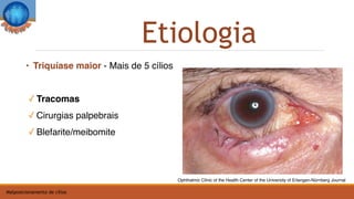 • Triquíase maior - Mais de 5 cílios
✓ Tracomas
✓ Cirurgias palpebrais
✓ Blefarite/meibomite
Etiologia
Ophthalmic Clinic of the Health Center of the University of Erlangen-Nürnberg Journal
Malposicionamento de cílios
 