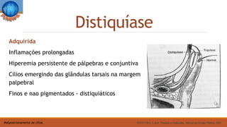 Distiquíase
Adquirida
Inflamações prolongadas
Hiperemia persistente de pálpebras e conjuntiva
Cilios emergindo das glândulas tarsais na margem
palpebral
Finos e nao pigmentados - distiquiáticos
MATAYOSHI, S. et al. Triquíase e Distiquíase, Manual de Cirurgia Plástica, 2004Malposicionamento de cílios
 