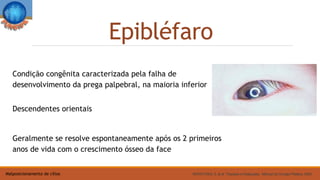 Epibléfaro
Condição congênita caracterizada pela falha de
desenvolvimento da prega palpebral, na maioria inferior
Descendentes orientais
Geralmente se resolve espontaneamente após os 2 primeiros
anos de vida com o crescimento ósseo da face
MATAYOSHI, S. et al. Triquíase e Distiquíase, Manual de Cirurgia Plástica, 2004Malposicionamento de cílios
 