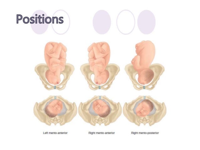 Malposition and malpresentations
