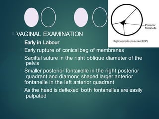  VAGINAL EXAMINATION
 Early in Labour
 Early rupture of conical bag of membranes
 Sagittal suture in the right oblique diameter of the
pelvis
 Smaller posterior fontanelle in the right posterior
quadrant and diamond shaped larger anterior
fontanelle in the left anterior quadrant
 As the head is deflexed, both fontanelles are easily
palpated
 