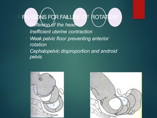  REASONS FOR FAILURE OF ROTATION
 Deflexion of the head
 Inefficient uterine contraction
 Weak pelvic floor preventing anterior
rotation
 Cephalopelvic disproportion and android
pelvis
 
