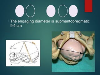  The engaging diameter is submentobregmatic
9.4 cm
 