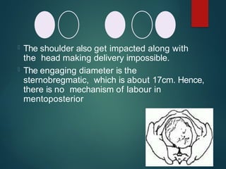  The shoulder also get impacted along with
the head making delivery impossible.
 The engaging diameter is the
sternobregmatic, which is about 17cm. Hence,
there is no mechanism of labour in
mentoposterior
 