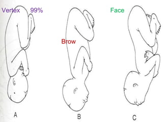 Vertex 99% Face
Brow
 