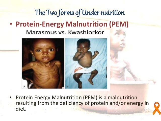 Malnutrition in Indian children