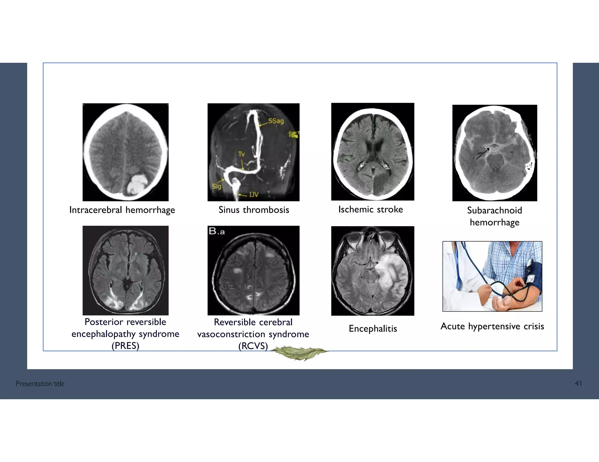 Intracerebral hemorrhage
Posterior reversible
encephalopathy syndrome
(PRES)
Sinus thrombosis
Reversible cerebral
vasoconstriction syndrome
(RCVS)
Encephalitis
Subarachnoid
hemorrhage
Acute hypertensive crisis
Presentation title 41
Ischemic stroke
 