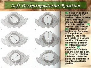 Left Occipitoposterior RotationLeft Occipitoposterior Rotation
• (A)(A) Fetus in cephalic
presentation LOP
position. View is from
outlet. The fetus
rotates 135 degrees
from this position. (B)(B)
Descent and flexion.
(C)(C) Internal rotation
beginning. Because
of the posterior
position, the head
will rotate in a longer
arc than if it were in
an anterior position.
(D)(D) Internal rotation
complete. (E)(E)
Extension; the face
and the chin are born.
(F)(F) External rotation;
the fetus rotates to
place the shoulder in
an anteroposterior
position
 