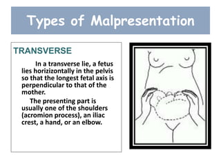Types of Malpresentation
TRANSVERSE
In a transverse lie, a fetus
lies horizizontally in the pelvis
so that the longest fetal axis is
perpendicular to that of the
mother.
The presenting part is
usually one of the shoulders
(acromion process), an iliac
crest, a hand, or an elbow.
 